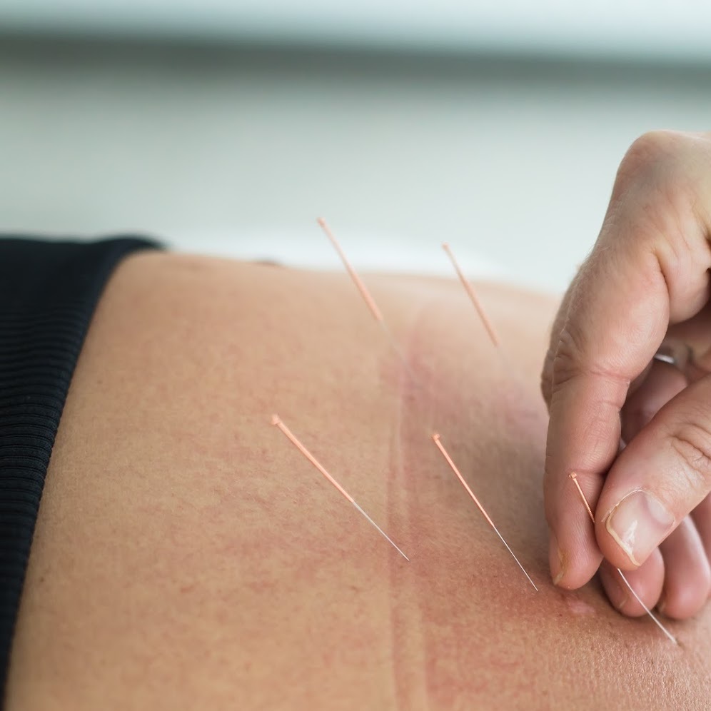 Acupunctuur